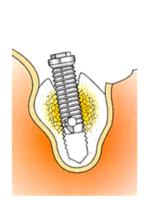 Clinics of dentistry for placement of dental implants.