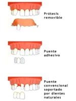 Placement of dental implants in dentistry clinics.