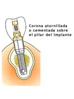 Dental implants and aesthetic dentistry in clinical implant.