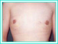 Reduction breast surgery for breast for large breasts.
