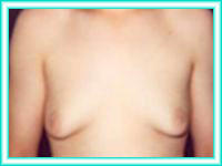 Reduction of large breasts and aesthetics breasts with surgery.