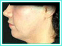 Facial surgery cheeks and chin facial surgery.