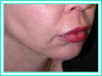 Surgery aesthetics of facial surgery chin and cheeks with lifting.