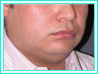 Cheek facial aesthetic surgery and facial lifting.