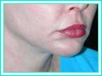 Lifting facial aesthetic surgery and facial chin.