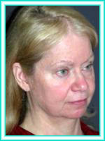 Facial rejuvenation with lifting of face and facial surgery.