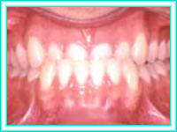Estetica dental puesta de brackets para ortodoncia en adultos.
