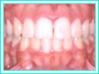 Dientes blanquemientos adultos estetica con brackets.