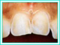 Aesthetic teeth and placement of teeth.