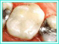 Implant teeth in dental clinic placement.