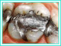 Dental implant in courses implant teeth.