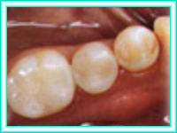 Aesthetic dental and dental implant placement.