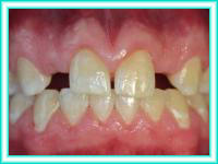Implant teeth and aesthetics of teeth in clinic.