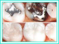 Placement of teeth with dental implants and aesthetics.