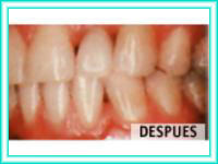 Clinic placement of implants and teeth