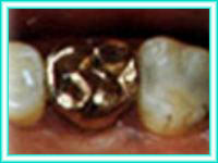 Implant teeth in dental implant courses.