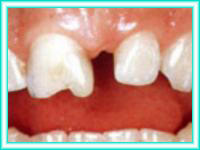 Implant teeth and placement in dental clinic.