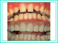 Placement of dental implants and teeth aesthetics.