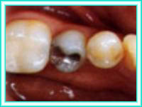 Dental implant and aesthetics in clinical implant.