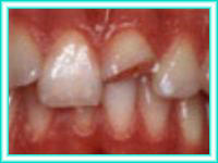 Dental implant dentistry ongoing aesthetics.
