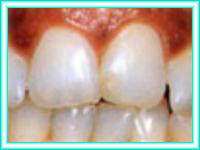 Dental implant and aesthetics in dental clinic.